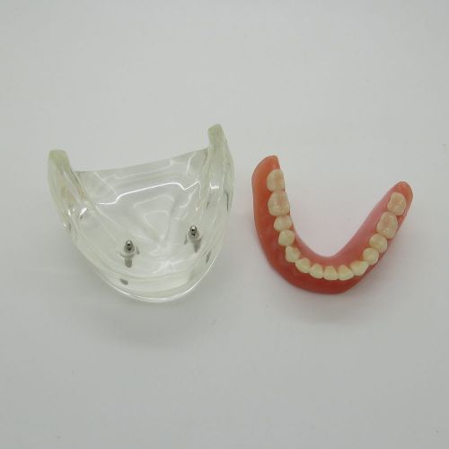 New Dental Model Overdenture Inferior with 2 Implants Demo #6002-01