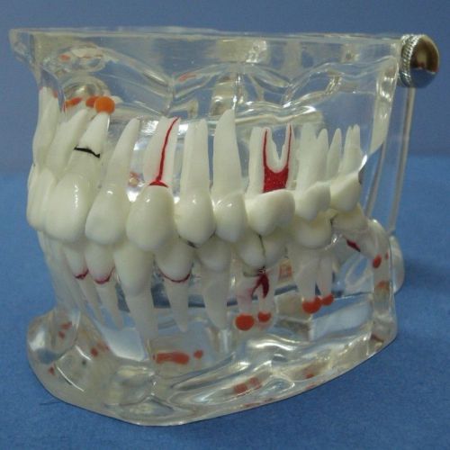 Crystal Transparent Standard Dental Oral Pathology Teaching Study Teeth Model