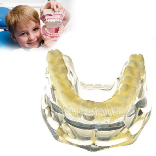 New Dental Implant Demonstration Model Teeth Study #6008 Free Shipping