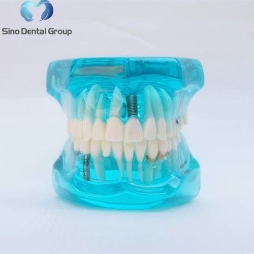 Sino Dental Typodont Teeth Teaching Model Restoration With Implant Blue Color
