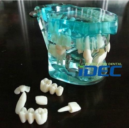Free shipping 1PC Blue Dental implant Study Model Teeth Implant Demostration