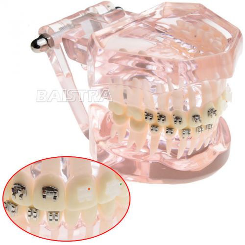 Dental Orthodontic Bracket Contrast Metal Ceramic Lingual Brace Teeth Model 3009
