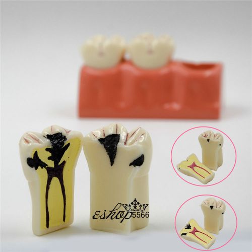 2 Pcs NEW 4:1 Size Dental Caries Removable Teeth Tooth Model Learn Study Model