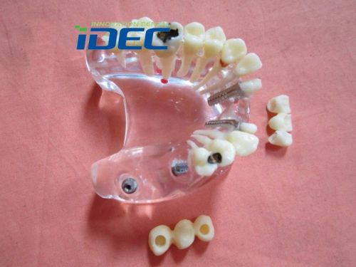 Free shipping 1PC Dental Study Teaching Model Teeth Implant Model with Caries