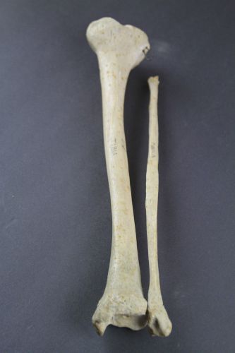 VTG Real Authentic Human Lower Leg Bones-Tibia/Fibula For Medical Use