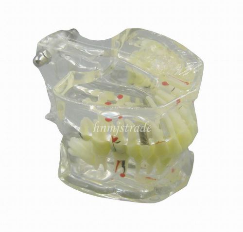 Dental Study Tooth Transparent Adult Pathological Teeth Model G167 hnmj