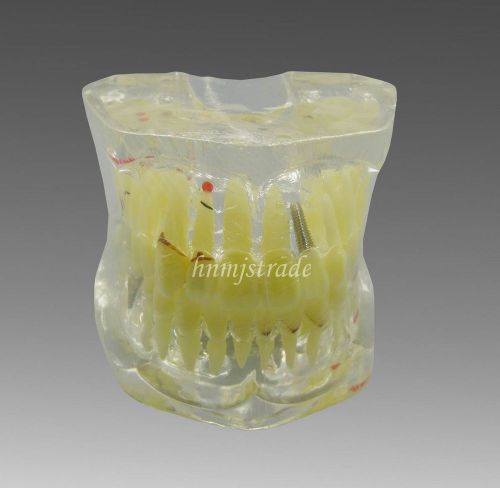 Dental Teeth Teaching Model 2Times Adult Pathologies Study Model G021 hnmj