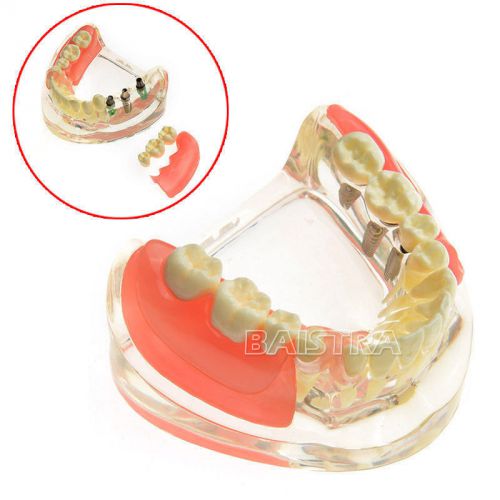 Dental Implant Restoration teeth model for Demonstration study and teach  #6006