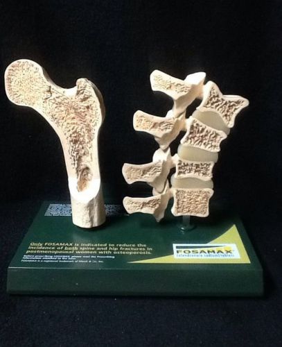 Fosamax - Hip Joint &amp; Spine Section Bone Anatomical Model in Postmenopause