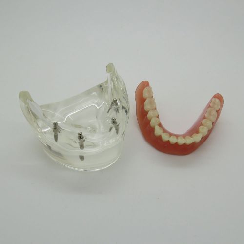New Dental Model Overdenture Inferior with 4 Implants Demo #6002-02
