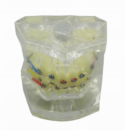1PcDental Orthodontic Treatment Study Model With Bracket and Arch Wire G091(ve)