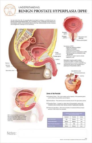 11 x 17 Post-It Disease Chart: BPH(Enlarged Prostate)