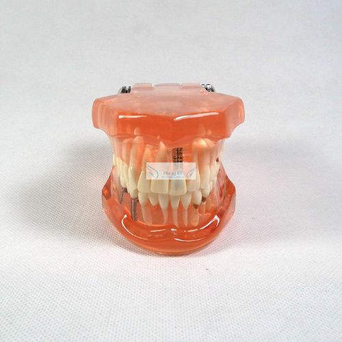 2PC HS Dental Implant Study Analysis Demonstration Teeth Model with Restoration