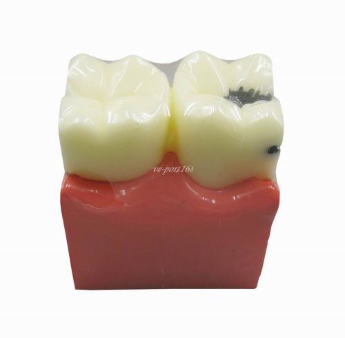 1PcDental Study Teeth Model Orthodont and Caries Comparison Teeth  G176 (ve)