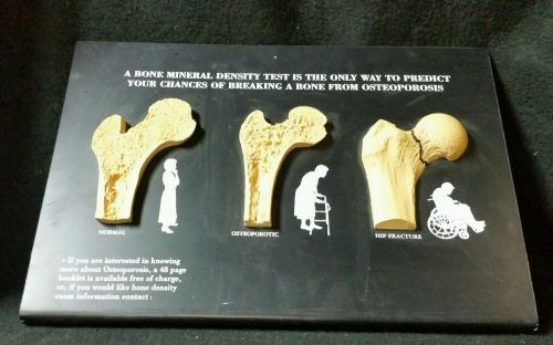 Vintage Milex Osteoporosis Femur Head Anatomical Model Human Bone Hip Fracture