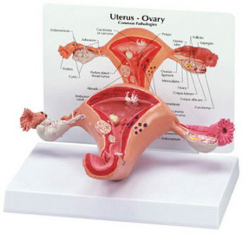 NEW Anatomical Uterus Ovary Cross Section Cancer Model