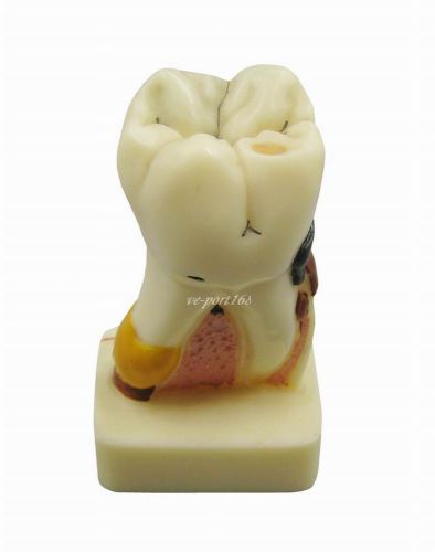 1Pc Dental 4times Pathological Teeth Model Teaching study Model G097 (ve)