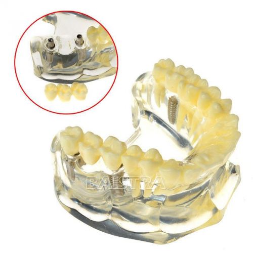 Big sale dental implant demonstration model teeth study #6008 free shipping for sale