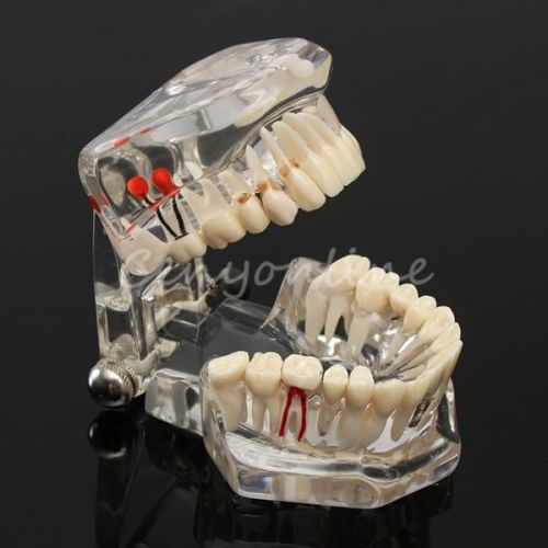 Dental Study Teach Implant Teeth Model Restoration Bridge Caries Tooth Education