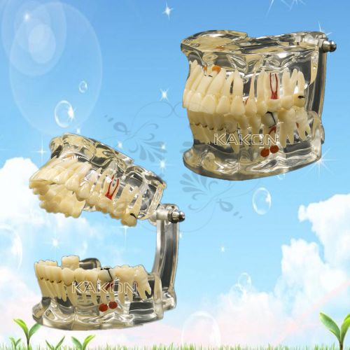 NEW Dental  Pathological Extrusion Missing Teeth Model Implant Disease Tooth