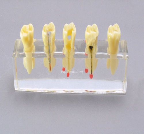 1*XINGXING 4012 Oral Root Treatment Tooth Model For Teaching 4012 High Quality