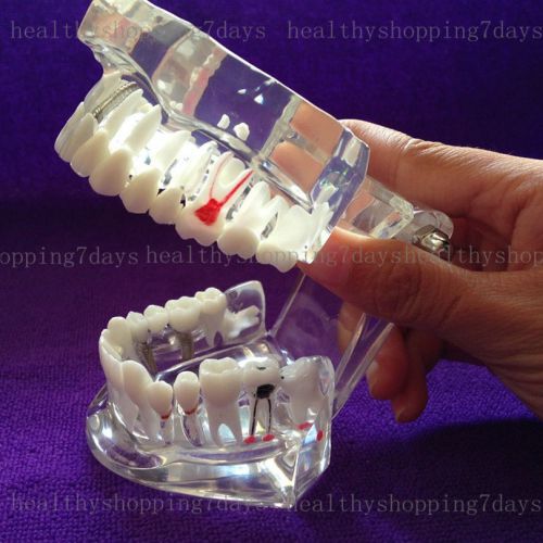 Free shipping Dental Implant Disease Teeth Model with Restoration &amp; Bridge Tooth