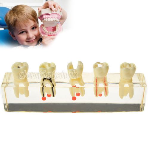 New Dental Teeth Study Teaching Model Endodontic Treatment Demonstration 4012