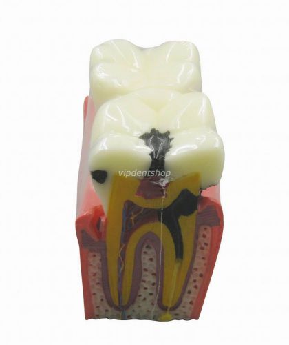 Dental Study Teeth Model Orthodont and Caries Comparison Teeth Model G176