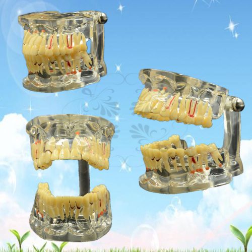 hot!!Adult Pathological &amp; Disease Transparent Teeth Model Dental Study Tooth