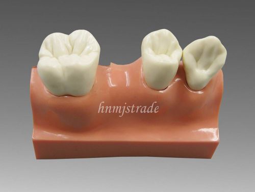 Dental Implant Study Analysis Demonstration Teeth Model G094 hnmj