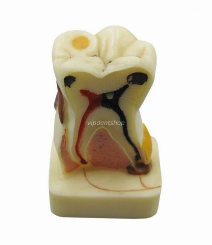 Dental 4times Pathological Teeth Model Teaching study Model G097