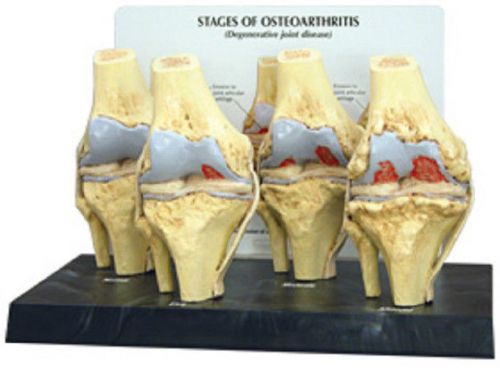 NEW 4-Stage Anatomical Human Osteoarthritis Knee Model
