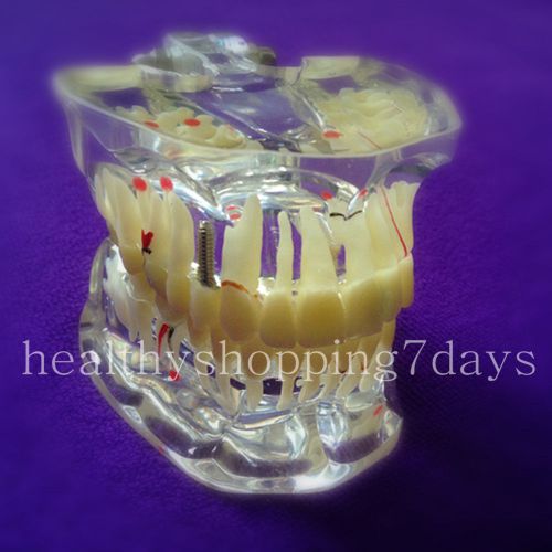 On sale Dental Study Tooth Transparent Adult Pathological &amp; Disease Teeth Model