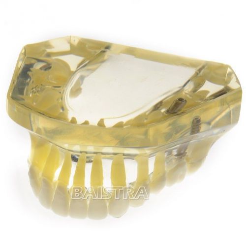 New Dental dentist teeth study implant model XYR-2010-I Free Shipping