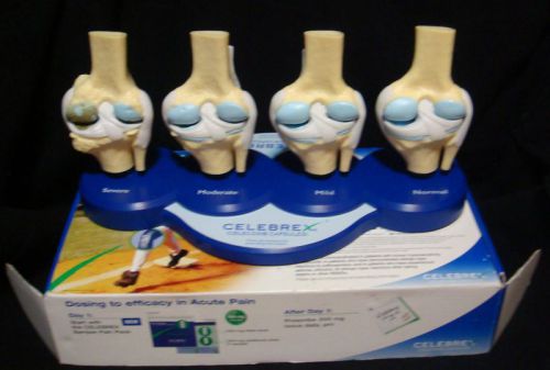 Anatomical Knee Joint Models Showing Arthritis Stages