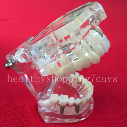 NEW Dental Implant Disease Teeth Model Restoration &amp; Bridge Tooth Ideal Medical