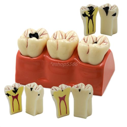 ONE Pcs 4:1 Size Dental Caries Removable Teeth Tooth Model Learn Study Model NEW