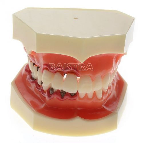 Dental Study Teeth Model Transparent Adult Pathological Model #4003
