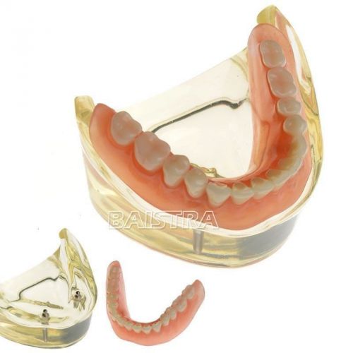 Promotion Dental Oerdenture Inferior 2 Implants Restoration Study Model #6002