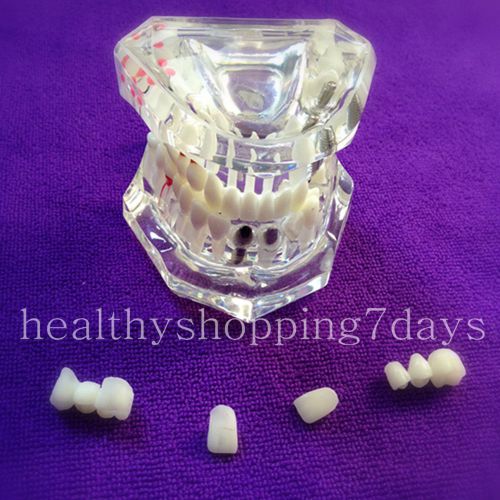 Dentist Dental Implant Disease Teeth Model with Restoration &amp; Bridge Tooth Study