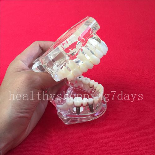 Hot Removable Dental Implant Disease Teeth Restoration Bridge Tooth study Model