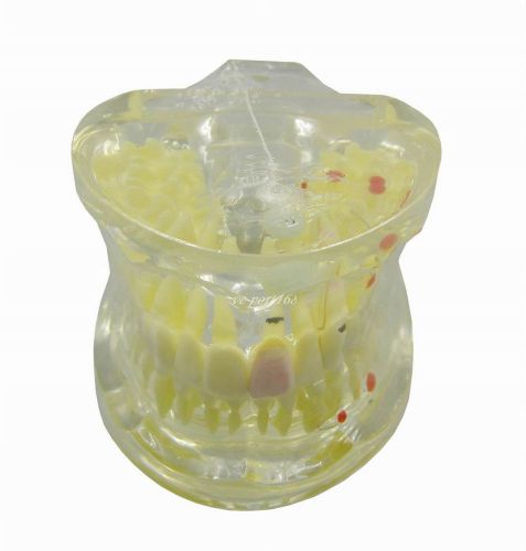 1Pc Dental Study Teeth Model Pathological Teeth Model For Adult G218 (ve)