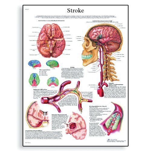 3B Scientific VR1627L Glossy Laminated Paper Stroke Anatomical Chart  Poster Siz