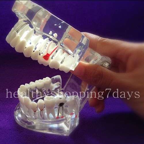 SALE 1pc Dental Implant Disease Teeth Model with Restoration &amp; Bridge Tooth