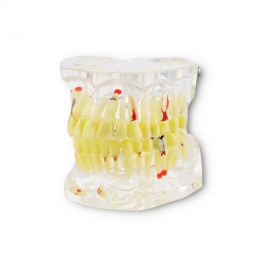 Dental implant disease tooth pathological teeth model to teacher student dentist for sale