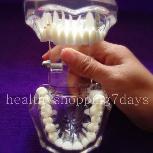 New year sale! Dental Implant Disease Teeth Model Restoration w/ Bridge Tooth