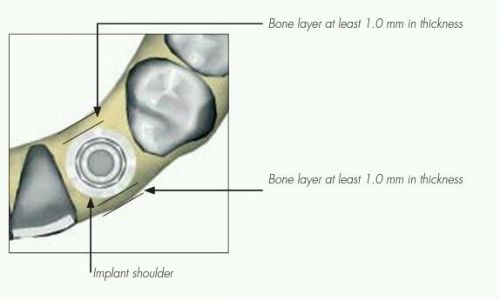 Dental implant diameter gauge combo - T gauge and indicator kit