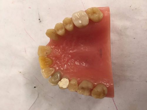 Vintage DENTAL UPPER STUDY MODEL DEMO LAMINATE PORCELAIN ONLAY MARYLAND BRIDGE