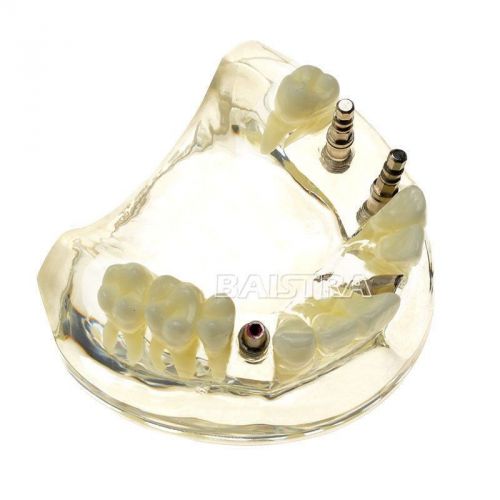 1 Pc New Dental tooth Model Teeth Implant Model with 4 implant nail ZYR-2005