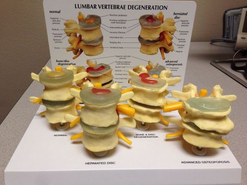 Lumbar Spine Degeneration Model Set 4 Stages